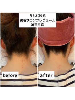 プレヴェール 神戸三宮/うなじ脱毛