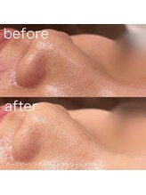 ルルラ リコ(lulula rico)/症例写真/ハイドラ毛穴洗浄