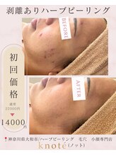 ノット(knote)/衝撃ビフォアフ5