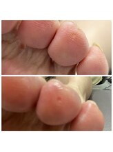 ドクターネイル爪革命 十条店/魚の目ケア