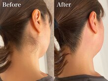 ラナ(Lana)/うなじW脱毛