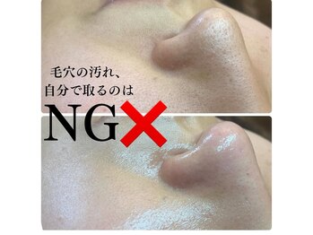 ピエル 北千住店(PIEL)/自分で毛穴汚れを取るのはNG