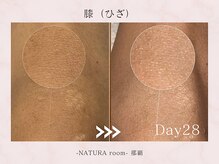 ナチュラルーム 那覇(NATURA room)/ローマピンク/ひざ施術
