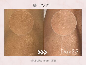 ナチュラルーム 那覇(NATURA room)/ローマピンク/ひざ施術