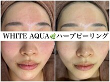 アワピール 天王寺店(AWA PEELL)/ハーブピーリング/ニキビケア