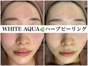 アワピール 天王寺店(AWA PEELL)/ハーブピーリング/ニキビケア