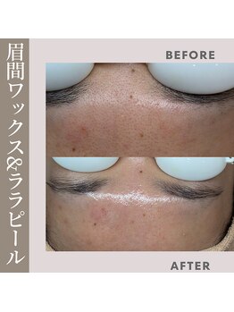 ジーンバイピエル 中野店(gene by PIEL)/#清潔感は肌から！/部分ワックス