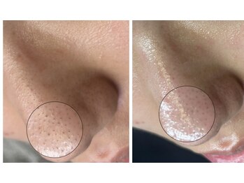 ユズドット(yuzu.)/頑固な毛穴も初回で!