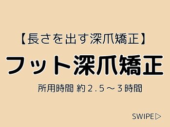 ブルームーンネイルズ(BLOOMOON.nails)/フット深爪矯正