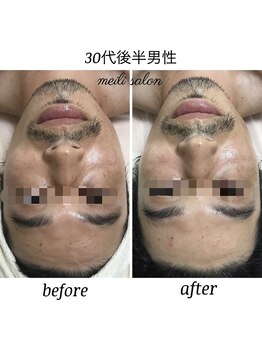 メイリー(MEILI)/男性もモテエステ