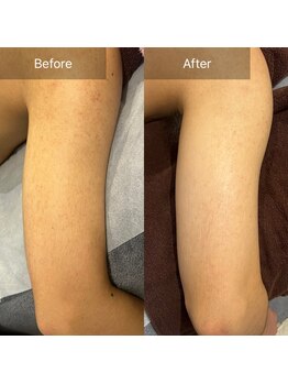 癒える(ielu)/ハーブピーリング二の腕★