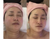 アムスパ(Aum Spa)/フォースカッターface