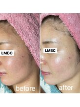 ルーチェエムベルシック(Luce.MBelChic)/スノーピールニ★