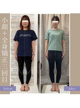 キアラ(chiara)/小顔＋全身矯正3回目(正面)