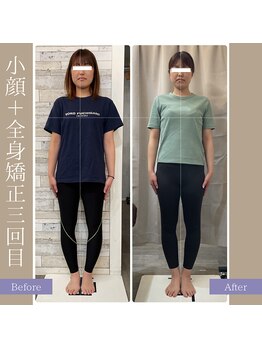 キアラ(chiara)/小顔＋全身矯正3回目(正面)