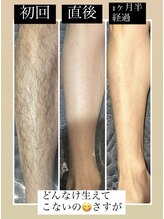 シエルボーイ(Cielboy)/ミックス脱毛の威力