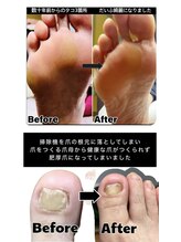 ウォーク(Walk)/トラブルフットケアコース