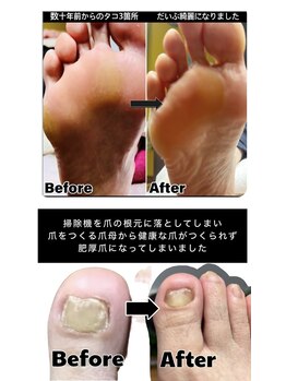 トラブルフットケアコース