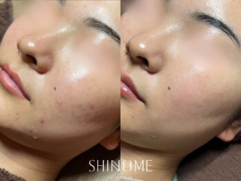 シノノメ(SHINONOME)/*きめ細やかな肌1