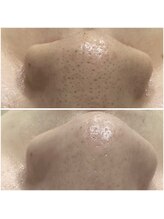 ミイン(美in)/毛穴洗浄