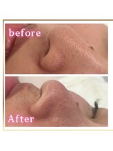 ピュアスキンサロン 恵比寿店(pure skin salon)/毛穴洗浄　ハイドラフェイシャル