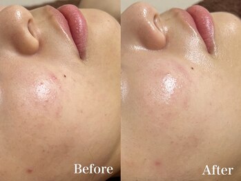 マシェ バイ マユ(Mache by Mayu)/ニキビケアは任せて☆