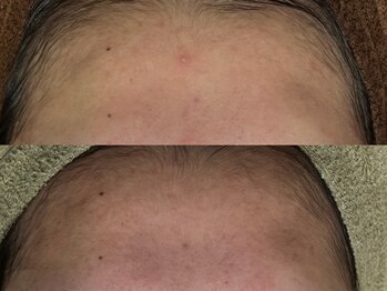 リボーン(REBORN)/一度でニキビ鎮静