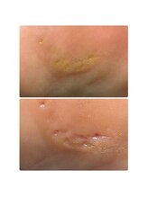 プラスキュア 用賀店(+CURE)/タコうおのめケア60分￥6600～