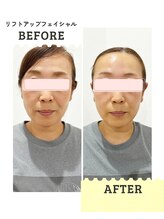 ブルーム(B.LOOM)/リフトアップフェイシャル