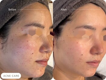 キュレイテッドスキン(CURATED SKIN)/ラミネーションピーリング