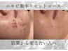 ニキビ肌集中リセットコース