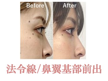 ラプリ 新宿店(Raplit)/隆鼻+輪郭矯正40分10回