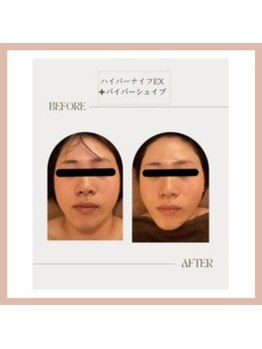 ラウレア(Laure'a)/ハイパーナイフEX/シェイプ