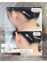 ポノ(PONO)/別人級！うなじ襟足脱毛☆