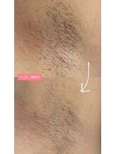 ロキュンプ(Rocyump)/大人気！脇脱毛