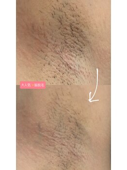 ロキュンプ(Rocyump)/大人気！脇脱毛