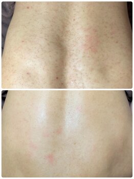 チュチュ(TUTU)/背中ケア