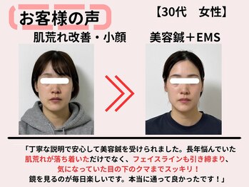 サロンスマイル/30代美容鍼ビフォーアフター