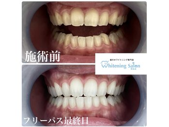 ホワイトニングサロン 熊本店/セルフホワイトニング