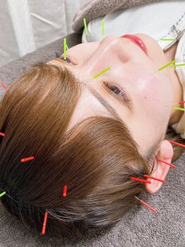 ハリシェンドの写真/痛みを最小限に抑えつつ、最大限の効果を引き出す◆お顔のケア～身体の不調改善まで出来る美容鍼灸!!