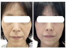 ミルフォイル(Milfoil)/小顔・たるみケア