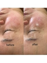 プルナモ(Purnama)/シミ集中ケア