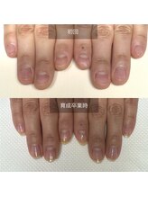 シープラス/自爪育成　祝　卒業！！