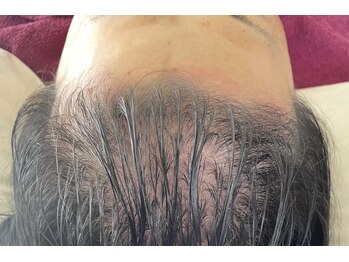 ボニータ(Bonita)/(ヘッド)ヒト羊膜幹細胞エステ