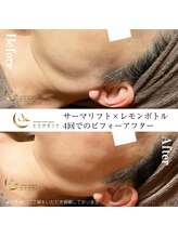 エスプリ 新宿店/サーマリフト×レモンボトル