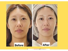 アン 銀座(ann)/レモンボトル