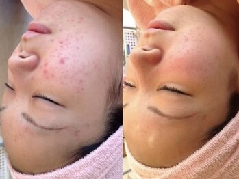 ヴィヴァンビー(Vivant+B)/before /after