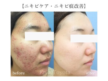 エピア 豊田店(Epia)/大人ニキビケア・赤み痕ケア