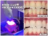 歯が白いだけでモテる！セルフホワイトニング初回30分