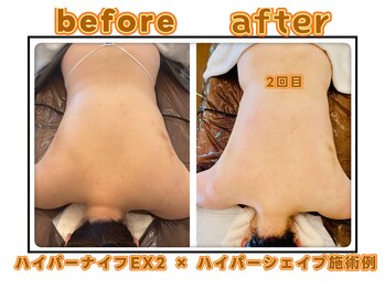 ドクタースタイル(Dr.style)の写真/ 最新型上位機種ハイパーナイフEX2認定店☆皮下脂肪層にアプローチし/内臓脂肪まで分解/サイズダウン実感